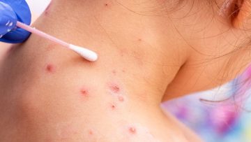 Sanidad-alerta-de-8-casos-sospechosos-de-viruela-del-mono-en-Espana-1
